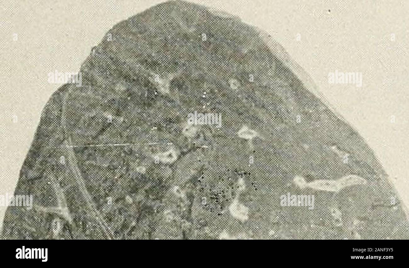 Erkrankungen der Brust und der Prinzipien der physischen Diagnose. nahtoderfahrenen Bazillen, etc., und dass diese zuletzt genannten Keime areoften die Ursachen der verschiedenen Komplikationen. Das letzte - mentionedconception bietet eine befriedigende Erklärung für die extremen variationswhich aufgetreten sind nicht nur schwere, sondern auch als zu aspectsof Proteanbrut verursacht die Krankheit. Es darf jedoch nicht vergessen werden, dass Es alreadysufficient Beweise der Glaube, dass gemischte Infektion ist nicht erforderlich sarily entscheidend für das Auftreten einer Lungenentzündung zu unterstützen. 1 Internaiional Kliniken, Bd. I, 29 Scries, 1919. Krankheiten der Stockfoto