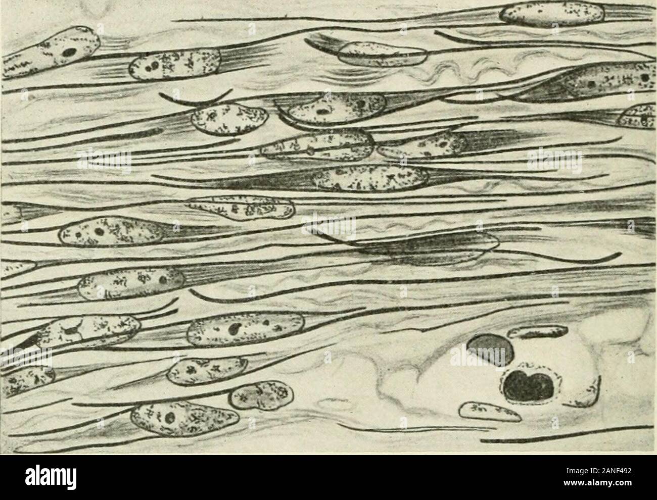 Myome und alliierten Tumoren (Myome und adenomyoma) ihre Pathologie