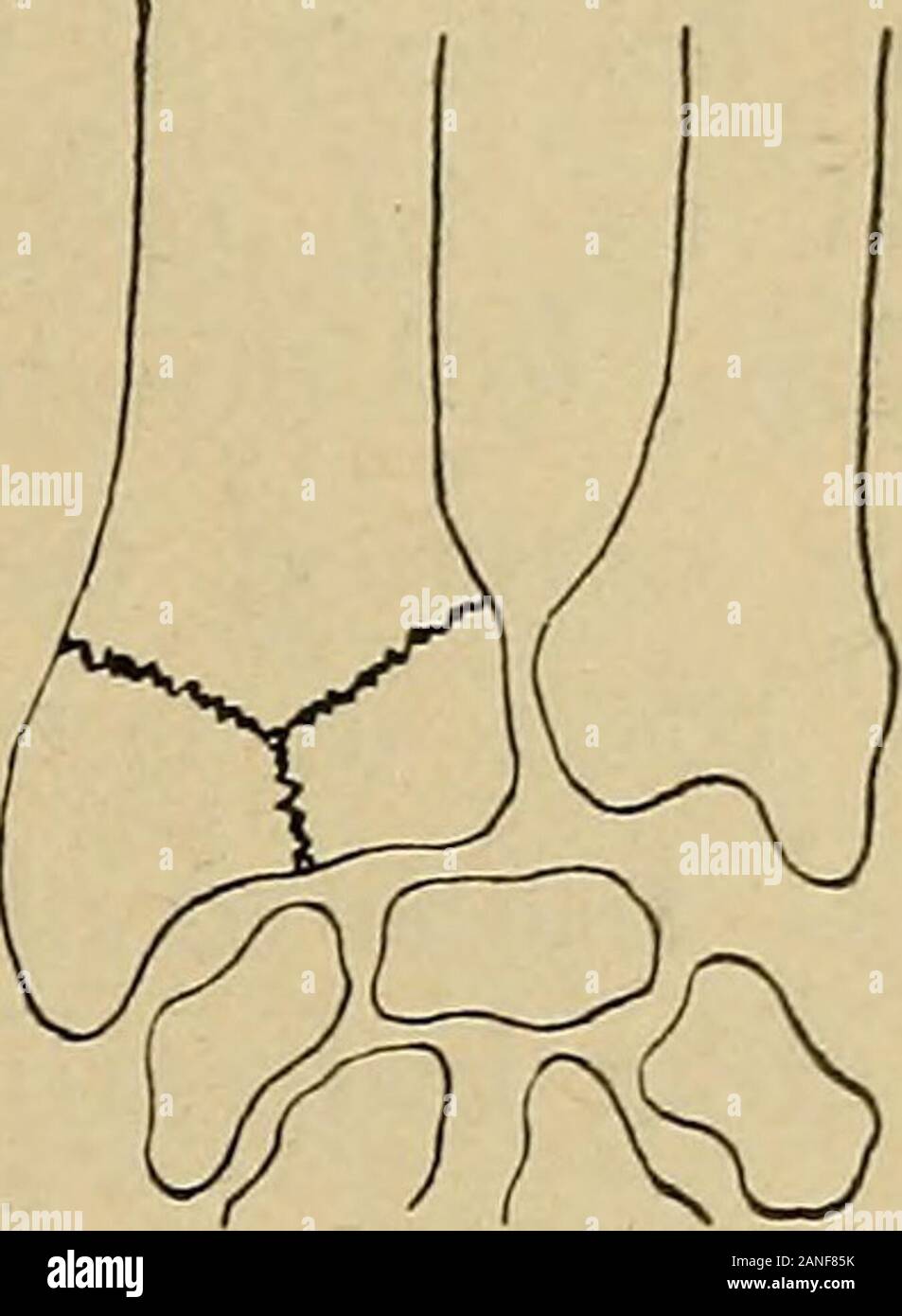 Atlas und Inbegriff von traumatischen Frakturen und Verrenkungen. Abb. 94 a und b. - gemeinsame Formen der kom- plette quer oder schräg Bruch. Abb. 95. - Mehrere frac-ture (Y-Fraktur); ein kom - dabei auftretende Form. Stockfoto