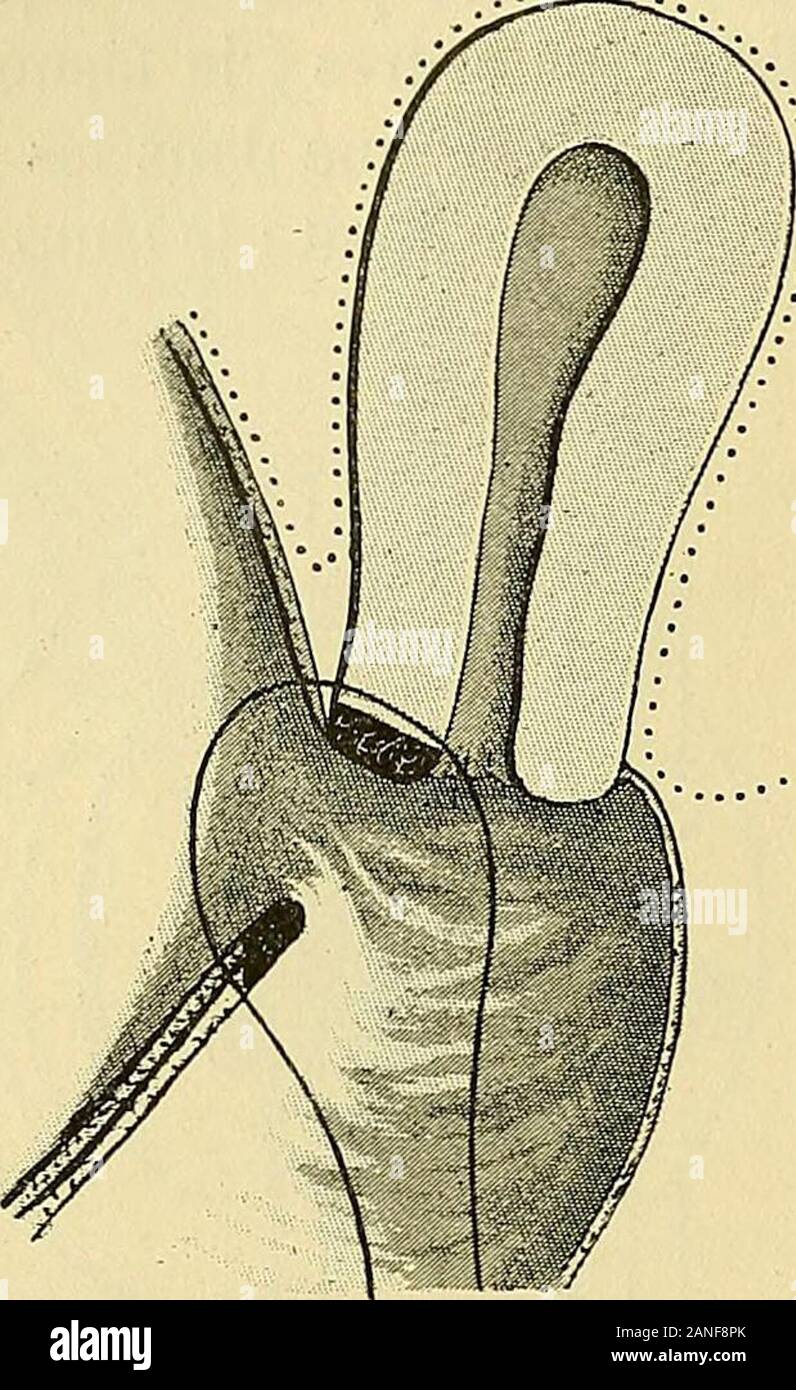 "Traité de gynécologie Clinique et opératoire. rectalede La vulve. 1 ÎNeugedauer. (Cenlr. w. Gijii., 1885, n° 9.) Lextraction du Kfz-prüfungen fut Faite et suivie delocclusion Nouvelle du vagin. - Bergmann. {Genlr. w. Gyn., 4888, n° 50.) Beobachtung decalcul phosphatique. Mort durémie causée par une néphrite interstitielle. - Baas. (Centr. w. Gyn., 1889, n° 21.) Le Kfz-prüfungen, phosphatique dabord développé dans le vagin oblitéré, Était passé ensuite dans la Vessie, à Travers La nécessité Große fistule qui avait Le colpo - cleisis. Il fut Extrait après Dilatation de lurèthre. 2 Vo r Halgaig. ne Et Le Fort. Mann Stockfoto