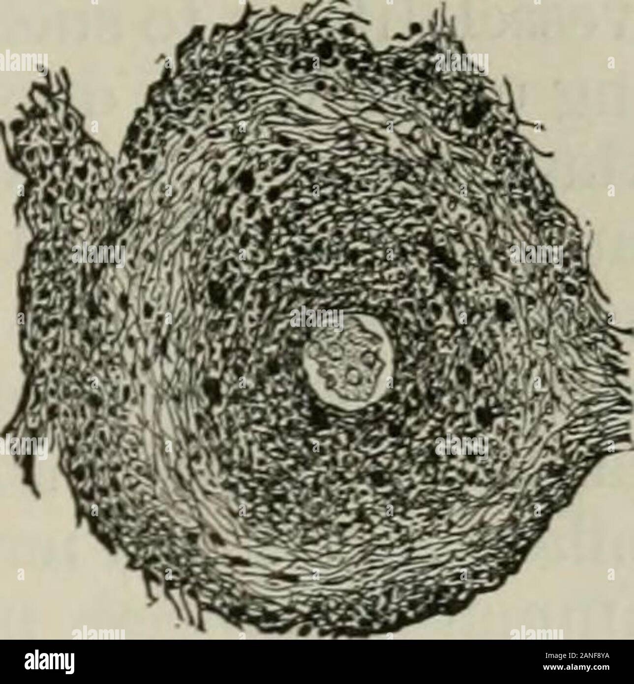 Die Internationale Enzyklopädie der Chirurgie; eine systematische Abhandlung über die Theorie und Praxis der Chirurgie. Syphilitische arteritis. Querschnitt eines segmentof die mittlere zerebrale Arterie einer Syphilitischen Patienten. Ich, der Verdickung der Intima; e, das Endothel;/, thefenestrated Membran; m, die muskulösen Mantel; a, theadventitia. (Von Barlows Proben, grünen Pa-thology.) Syphilitische arteritis. Ausschnitt aus einer kleinen Arterie der Pia mater Schnitt quer, zeigt die inneren coatmuch verdickt, eine Verminderung des Lumen der VES-sel, und eine beträchtliche Infiltration der Adventitia. Aclot ist gesehen Stockfoto