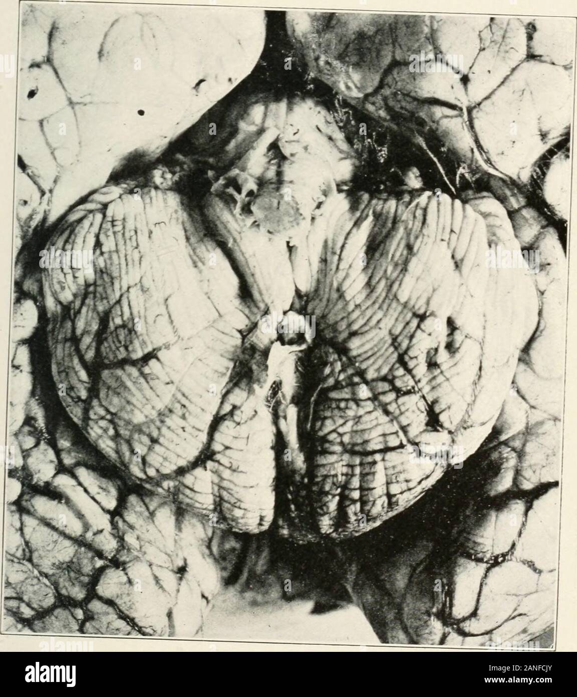 AMAarchives für Neurologie & Psychiatrie. ed Inhalt zuvor, linke keinen Grund - lage, Zweifel an der dermoid Charakter. Fall 3.-Extreme Grad der internen hydroceplialus zvitli intraeranial pressuresymptoms. Betrieb zvithout Offenlegung von Tumor. Leichenschau: Haare - containingcholesteatoma von imdersurface des Kleinhirns, die Perlmutt Aussehen. Geschichte.-E. C, eine weiße, weibliches Kind 2 Jahre alt, zugelassen 31.01.1920, wurde von Dr. Z. L. Shaw von Manchester, N.H. Die Beschwerde wurde: Großer Kopf bezeichnet. Die Geschichte der Familie wurde uniinportant. Das Kind war-1 mitvollgas Begriff ohne Instrumente geboren. Er Stockfoto