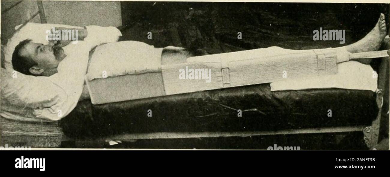 Die Praxis der Chirurgie. Abb. 603.- Fraktur des tlie thigli. Abgeschlossene Apparate, wie in Abb. 602, und inaddition Eine lange außerhalb T-Schiene, Schlaufen und Landstrich. Ein achter angewendet (scudder). Das wichtigste Merkmal der Dressing ist jedoch die Erweiterung. Die Erweiterung die Gurte sind aus 3 cm unter dem Sitz der Frac durchgeführt- tur, eine Riemenscheibe, wie im Text dargestellt wird, und der Fuß des thebed angehoben ist Foi-counterextension, wie in Fällen des Bruchs des neckof den Oberschenkelknochen. Dollars Erweiterung ist ein praktisches Gerät für thetreatment von zusammengesetzten Frakturen, sowie für die Behandlung von Stockfoto