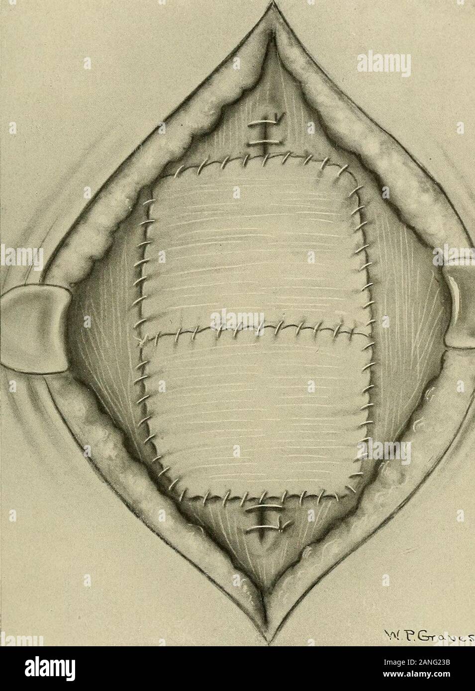 Gynäkologie. Abb. 388.- Transplantation der Fascia Lata für die postoperative Hernie (Bartletts Methode). Angezeigt Methode der sezieren Faszie aus der Keule. in der Form eines Parallelogramms und in warmen normale Salzlösung gelegt untilneeded. Die Wunde des Beines ist geschlossen. Die Abdominal- Wunde wird dann aufgedeckt. Ohne incisionin der Faszie des hernial Überstand invertiert wird und die Kanten der gedreht - inportion genäht mit catgut, Sorgfalt ausgeübt wird, nicht der Faszie durchstoßen sodeeply als zu verletzen eine Schleife des Darmes, die eng haftende unter werden. Operationen AUF DIE BAUCHDECKE 683 Stockfoto