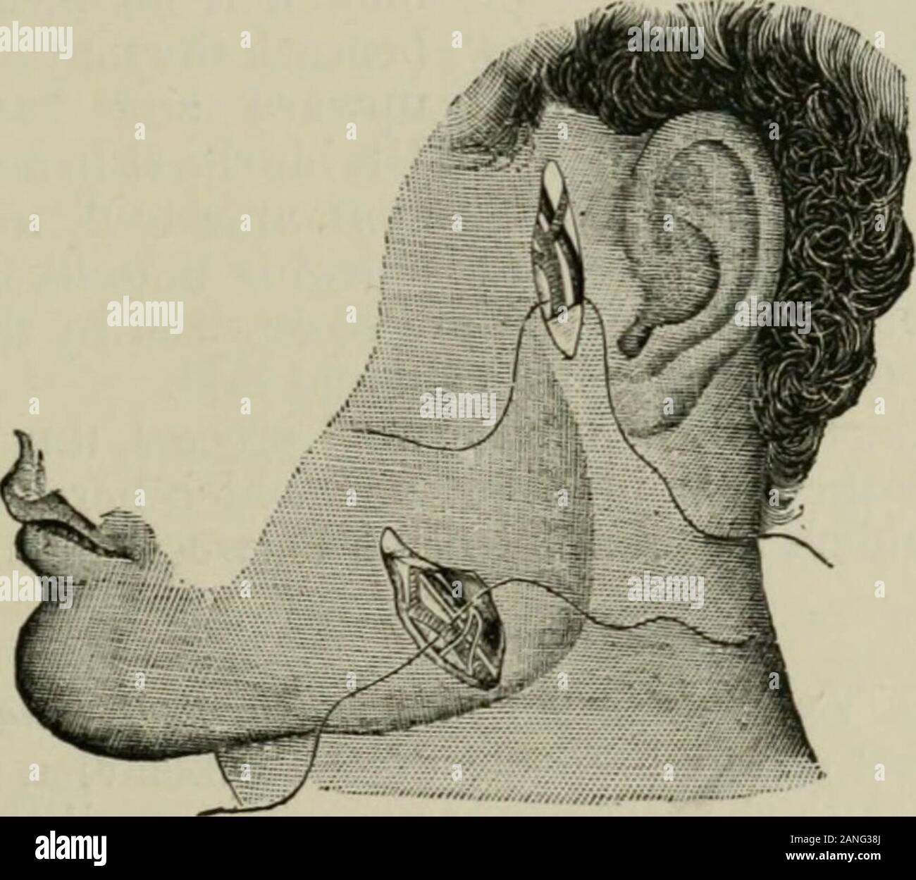 Die Internationale Enzyklopädie der Chirurgie; eine systematische Abhandlung über die Theorie und Praxis der Chirurgie. ed. Dann Kurven über Körper des Unterkiefers, in der Nähe der vorderen unteren Winkel des massetermuscle, steigt auf den Winkel der Mund, und von dort in die inneren canthus ofthe Auge, wo es die kantige Arterie benannt ist. Über die buccinator muscleits Kurs ist gewunden, sich die Bewegungen der Kiefer. Unterhalb des Kiefers, es verläuft unter der digastric und stylo-hyoid Muskeln; der Körper des Kiefers es durch die Haut bedeckt ist, oberflächlichen Faszie und platysmamyoides und liegt Stockfoto