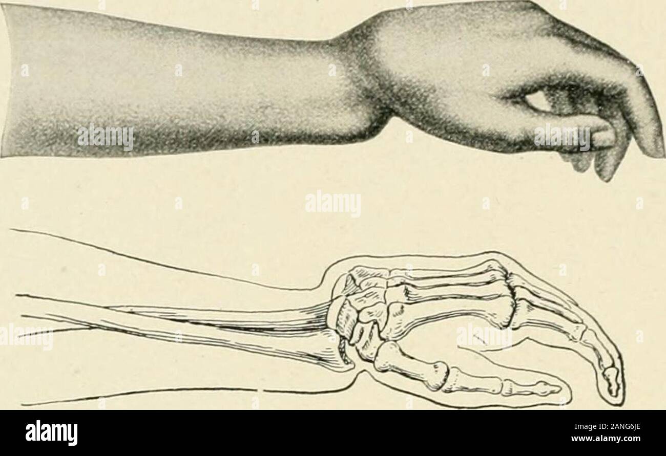 Die Praxis der Chirurgie. ig. 578.- Colles Bruch. Drängen die Fragmente zusammen für die Diagnose. Punkt wo die radiale styloid der Welle verbindet. Man sollte den normalen Bewegungen der Hand, Handgelenk und Arm, Flexion, Extension, Thepatient und Rotation. Dann beobachten wir die Missbildungen des beschädigten Arm; Die wristappears unnatürlich; in extremen Fällen können wir auf einmal die familiarsilver-Gabel Mißbildung sehen; die Handballen Eminenz ist höher und näher am Handgelenk als normal. Die ganze Hand ist etwas entführt unddie styloid Prozess des Radius ist nicht mehr auf einem niedrigeren Niveau als 88 gefunden Stockfoto