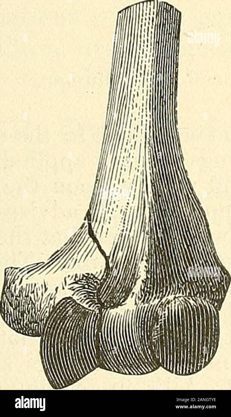 Eine praktische Abhandlung über Brüche und Verwerfungen. s, Vol. xiv. Alsopaper lesen Sie vor N.Y. Surg. Soc, Mai, 1880. Frakturen DES INTERNEN KONDYLUS 257 knöcherne Ankylose wird manchmal ergeben, und unter unsachgemäßer Behandlung es unvermeidlich isalmost. [Befugnisse, 1 von New York, berichtet über zwölf Fälle; neun perfekt erholt theirfunctions; ein 5° hatte kurze von kompletten Verlängerung; keiner hatte Deformität.] Poinsot sagt, dass von fünf Fällen gemeldet von Senftleben, nur eine recoveredwithout Ankylose. In einem Fall, wo Ankylose re-sulted, der Betrieb der Resektion des Winkelstücks Termi-Abb. 129. tödlich gerechnet. Ich T Stockfoto