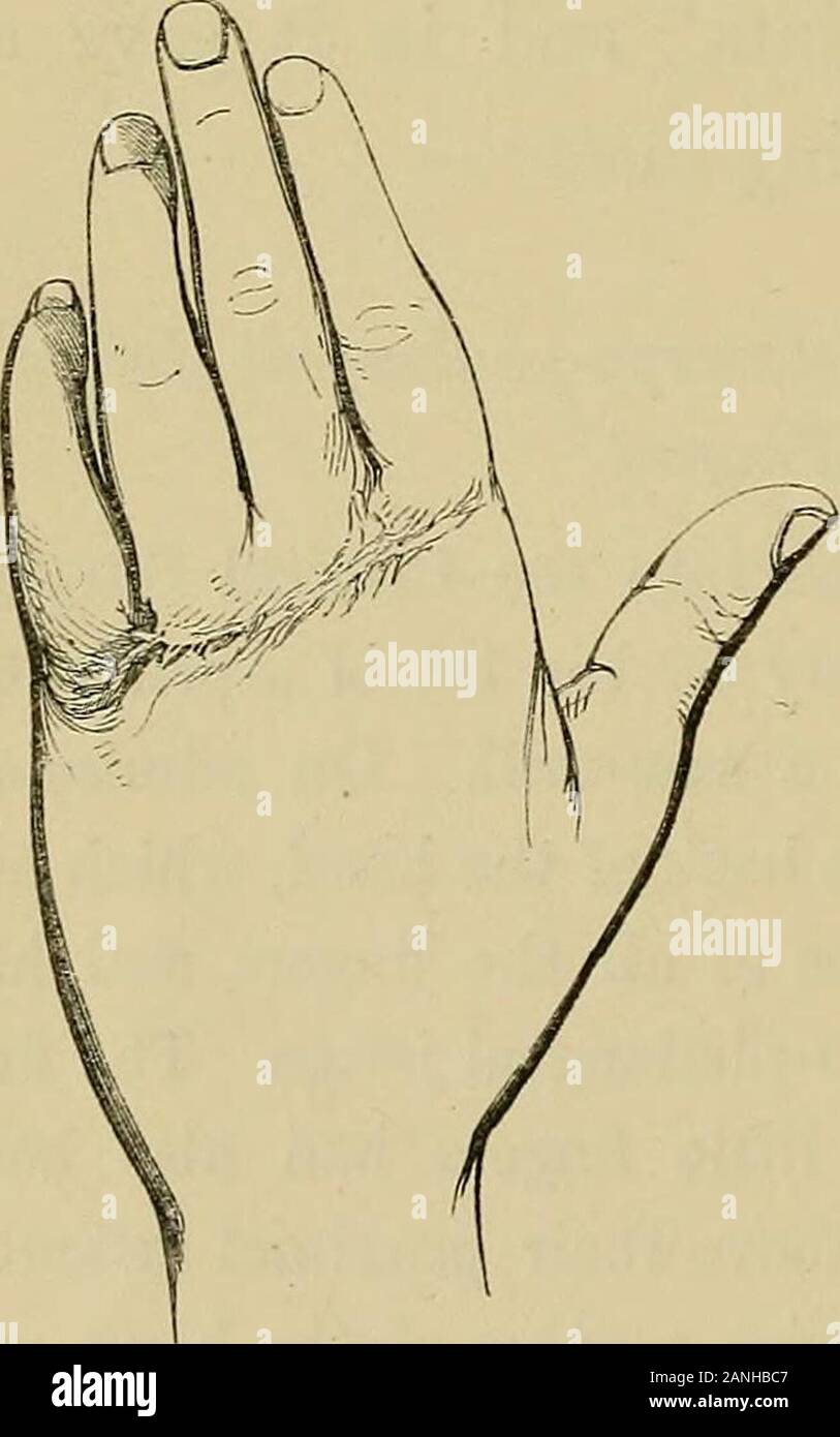 Die Missbildungen, Krankheiten und Verletzungen der Finger und Zehen und ihre chirurgische Behandlung. Finger hatte auch beensawn durch, sofort über Ihren proximalen articularextremities, so dass der vordere Teil der Hand wasonly zu den hinteren Teil von wenig mehr als die flexor Sehnen und Haut auf der Palme der Hand befestigt. Demdaumen war unverletzt. Denken Sie recht Der handa Chance auf Erholung zu geben, habe ich die Gelenkknorpel Extremitäten 262 EXZISION DER GELENKE UND DES metacarpal und phalangeal Honest verbunden mitdem metacarpophalangeal Verbindungen der vier Fingern. Thehand Stockfoto