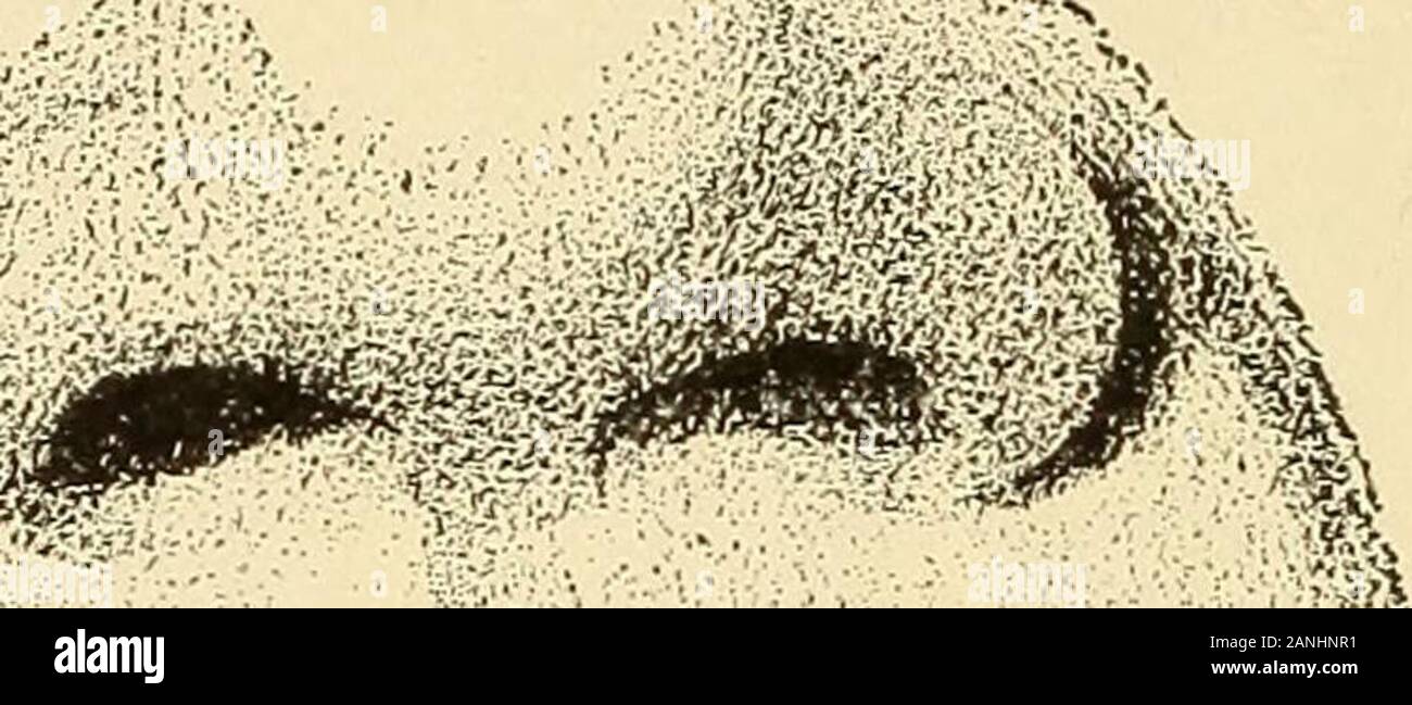 Ein text-Buch über Erkrankungen der Hals-, Nasen- und Ohren. - 14 Median stction an Kopf und Hals. (Quain, nach Braune.) 1, sphenoidal Sinus; 2, seitliche recessof Rachen; 3, rachenentzündungen Öffnung der Eustachischen Röhre; -1, anterior Bogen des Atlas; 5, weichen Gaumen; 6, bodyof Achse; 7, Mündlicher Teil des Rachens; 8, kehldeckel; 9, arytenoid Muskel; 10, cricoid Knorpel; 11, Luftröhre, Speiseröhre; 12; 13, Herkunft von Innominate Arterie von aorta; Li, genioglossus Muskel; 15, geniohyoid Muskel; 16, Mylohyoid Muskel; 17, platysma; IST, zungenbein 19, schildknorpel; 20, 21; cricoid Knorpel, Isthmus von Thyroi Stockfoto