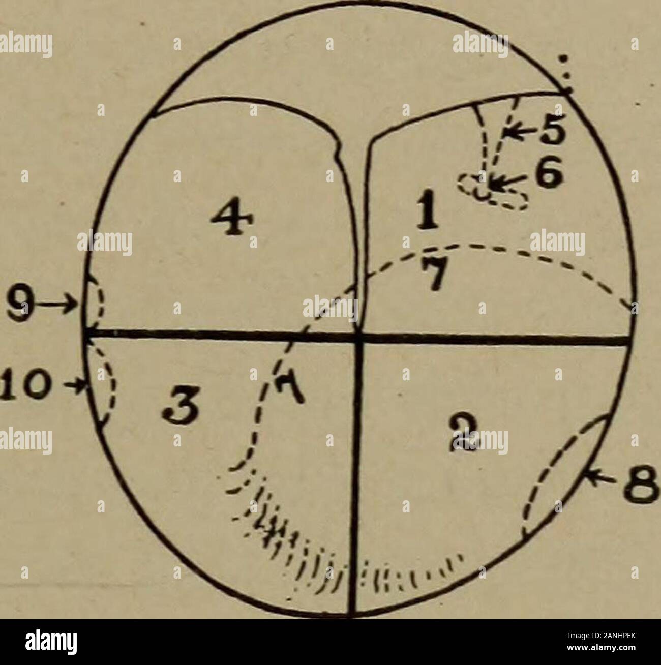 Ein Handbuch der otologie für Studierende und Praktiker. Membrana tensa. Shrapnells Membran ist von großer Bedeutung, da es der einzige Teil der Wand des Gewölbes, oder oberen Teil Tympanon der Buchse, die direkt untersucht werden können. Ithas im normalen Zustand über das Aussehen der Haut. Es ist von einem zarten rosa Farbe, ohne Glanz als METHODE DER UNTERSUCHUNG 57 mit der Membrana tensa. Es ist die kontinuierliche mit und von Thesame aussehen wie die Superior canal Wand. Durch die Schräglage des anterioren und posterioren Falten, und sinceit füllt im Segment der Kreis, die vertikale Messtechnik Stockfoto