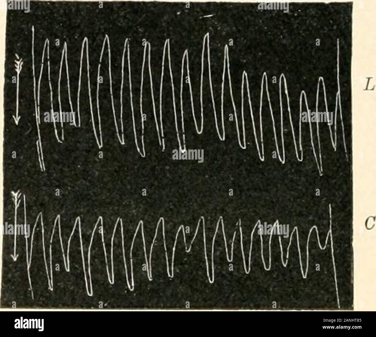 Die menschliche Physiologie. Fin. SO.-rhythmische Kontraktionen des Darmes. (Bayliss und Starling.) EIN, der systolische und diastolicmovements des Darmes. Ballon-Methode. Zeit Markierung = 0 Sekunden. B, gleichen Bewegungen asA, durch zwei enterograplis, die synchrone Aktivität von Längs- (7.) andcircular ((.) Muskel-Fasern an der gleichen Stelle aufgenommen. Der absteigende Richtung der Pfeile indicatesdirection der Kontraktion. 1 rhythmische Aktivität, die in den Muskelzellen, und dass Sie durch muskulöse Wärmeleitung propagiert, wie von Engelmann, Gaskell angenommen, und Fauo für Herzrhythmusstörungen. Im direkten Widerspruch zu diesem t Stockfoto Die menschliche Physiologie. Fin. SO.-rhythmische Kontraktionen des Darmes. (Bayliss und Starling.) EIN, der systolische und diastolicmovements des Darmes. Ballon-Methode. Zeit Markierung = 0 Sekunden. B, gleichen Bewegungen asA, durch zwei enterograplis, die synchrone Aktivität von Längs- (7.) andcircular ((.) Muskel-Fasern an der gleichen Stelle aufgenommen. Der absteigende Richtung der Pfeile indicatesdirection der Kontraktion. 1 rhythmische Aktivität, die in den Muskelzellen, und dass Sie durch muskulöse Wärmeleitung propagiert, wie von Engelmann, Gaskell angenommen, und Fauo für Herzrhythmusstörungen. Im direkten Widerspruch zu diesem t Stockfoto