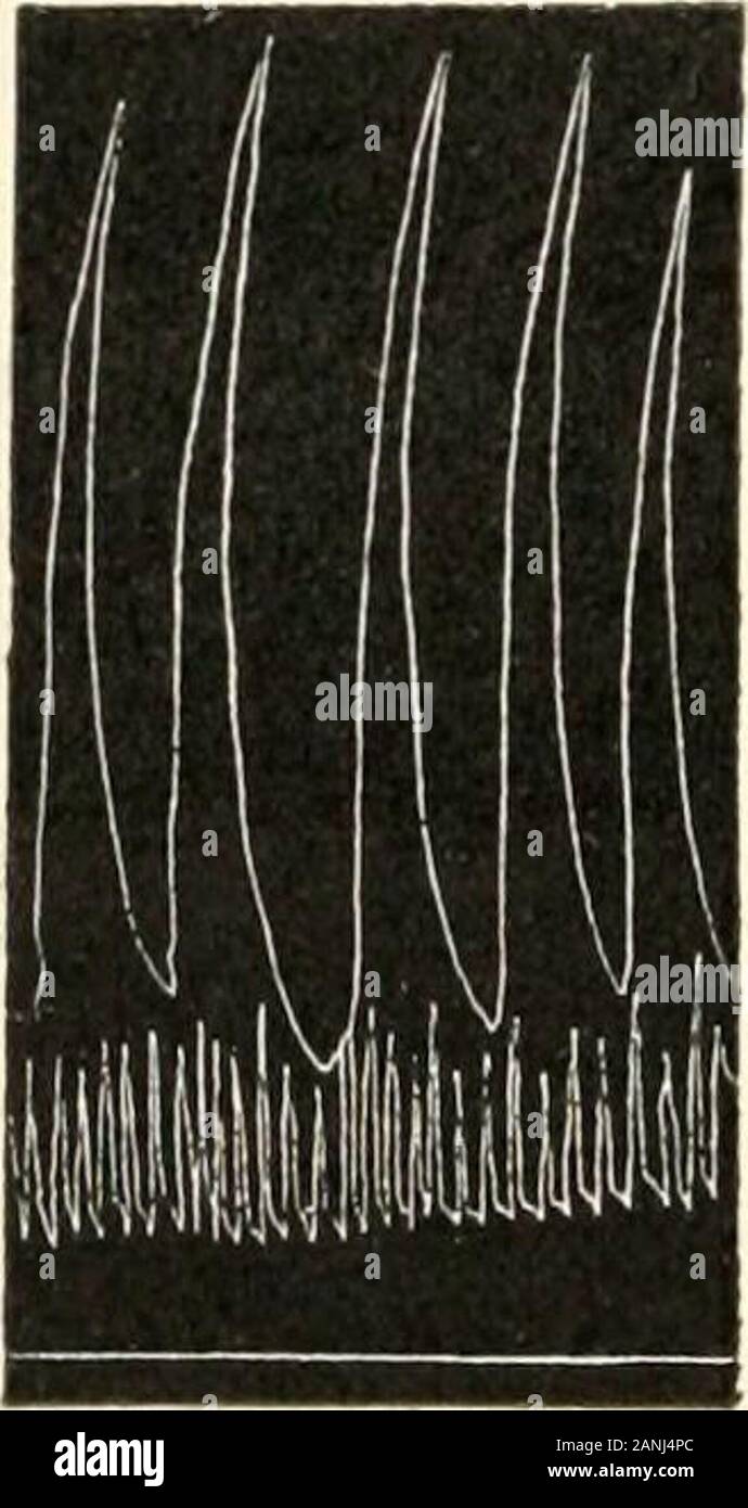 Die menschliche Physiologie. Bewegungen, die undersame Bedingungen wie Abb. 60, mit Sound eingeführt und intocardia Fundus des Magens (Ducceschi.) 188 PHYSIOLOGIE CHAP. selten. Diese Wellen haben eine Laufzeit von 35-55 sieht.; theiramplitude in der Regel übersteigt die Exkursion der Hebel zu schreiben. Wenn der Klang wird in der pyloric Antrum eingeführt, ein verydistinct Form der rhythmischen Bewegung erscheint, bestehend ofsystoles und diastoles in regelmäßiger Folge, die determinedby die Kontraktion und Entspannung der Muskeln der antrum (Abb. 63). Jede Umdrehung dauert 10-30 sieht, d. h. eine kürzere periodt Stockfoto Die menschliche Physiologie. Bewegungen, die undersame Bedingungen wie Abb. 60, mit Sound eingeführt und intocardia Fundus des Magens (Ducceschi.) 188 PHYSIOLOGIE CHAP. selten. Diese Wellen haben eine Laufzeit von 35-55 sieht.; theiramplitude in der Regel übersteigt die Exkursion der Hebel zu schreiben. Wenn der Klang wird in der pyloric Antrum eingeführt, ein verydistinct Form der rhythmischen Bewegung erscheint, bestehend ofsystoles und diastoles in regelmäßiger Folge, die determinedby die Kontraktion und Entspannung der Muskeln der antrum (Abb. 63). Jede Umdrehung dauert 10-30 sieht, d. h. eine kürzere periodt Stockfoto