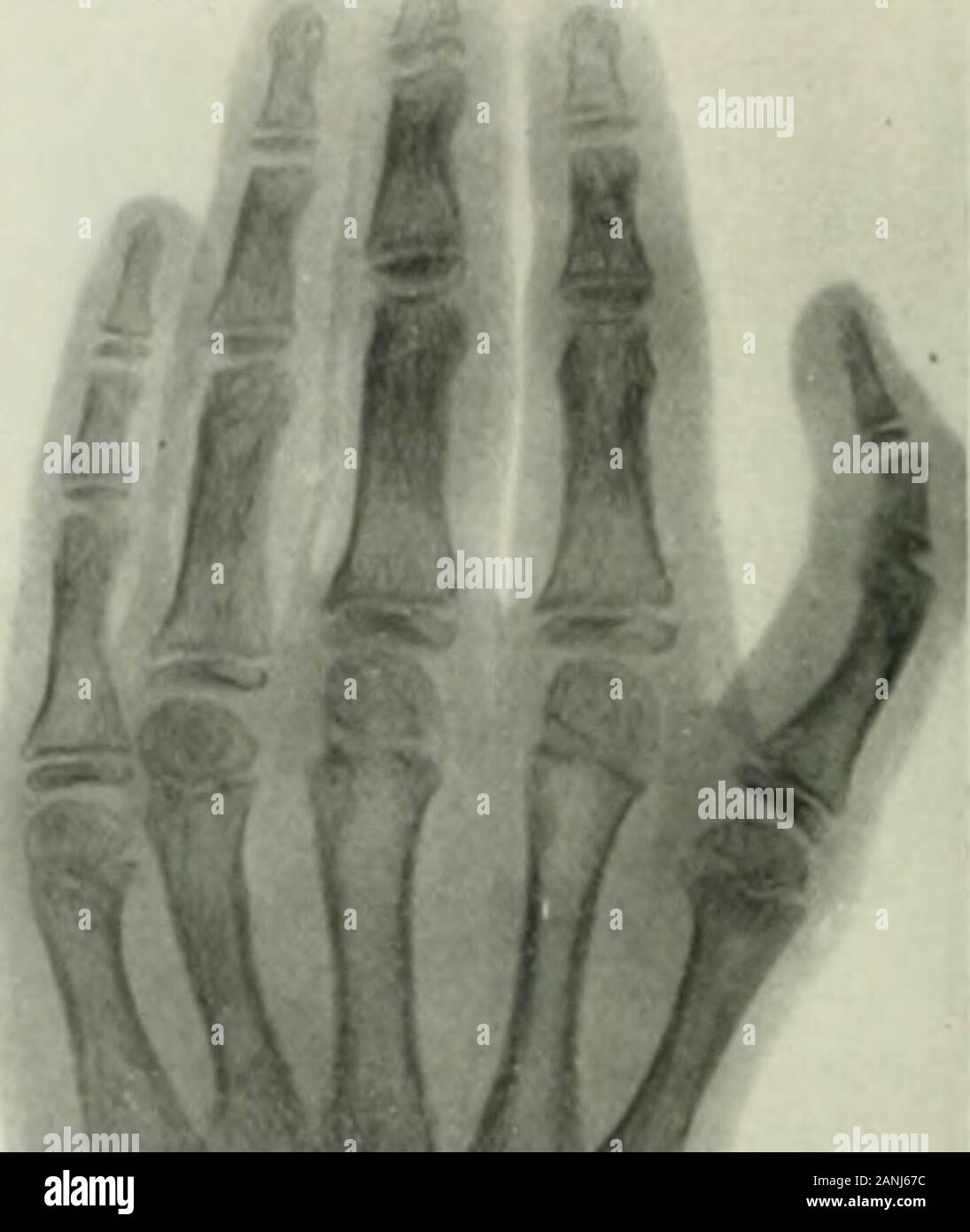 Die anatomischen Datensatz. Abbn. 7 Iiiul. s Links und ii^; lii Li.-mds von. Sohn der anderen entsprechenden phalanfjes liut dennoch als. in hunre angezeigt. • Es ist eine separate Knochen mit einem ausgeprägten diajihysisand Epiphyse, Gelenkflächen und Base und Kopf. Die Besidesshowing. gleichen Besonderheiten in Bezug auf die zusätzlichen i) halanx, die metacarpal der Daumen zeigt eine doppelte Epiphyse (Abbn. Sand 11). In allen Fällen von drei Gelenkwelle Daumen berichtet, dieser Verordnung, der Mitte i) halanx ist Con> idered die extra Phalanx. iiYri; iuiiAi, A. (; isM 121 Pfitziior,!) (), die Arbeit mehr als jeder getan hat Stockfoto