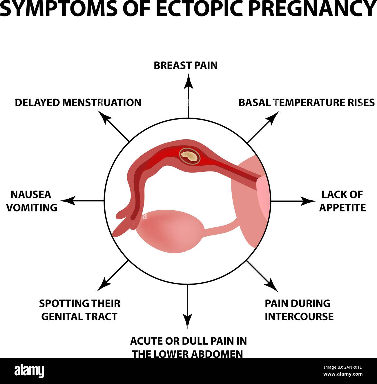 Symptome einer ektopen Schwangerschaft. Infografiken. Vector Illustration auf isolierte Hintergrund. Stock Vektor