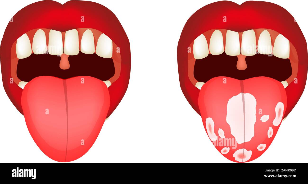 Candidose der Zunge, Soor. Entzündung der Zunge. Infografiken. Vector Illustration auf isolierte Hintergrund. Stock Vektor