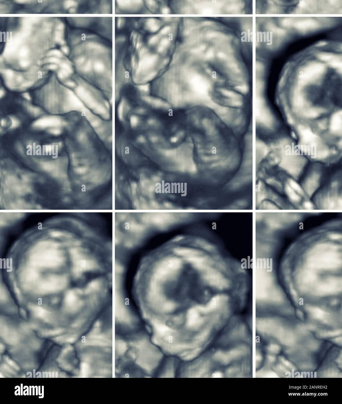 Bilder von 4D-Ultraschall der Baby in Mutters Schoß. Collage aus 3D-Echographie Bilder. Stockfoto