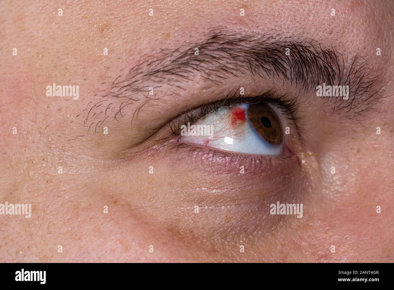 Plötzliche Einblutung Unter Dem Auge www.alamy.de
