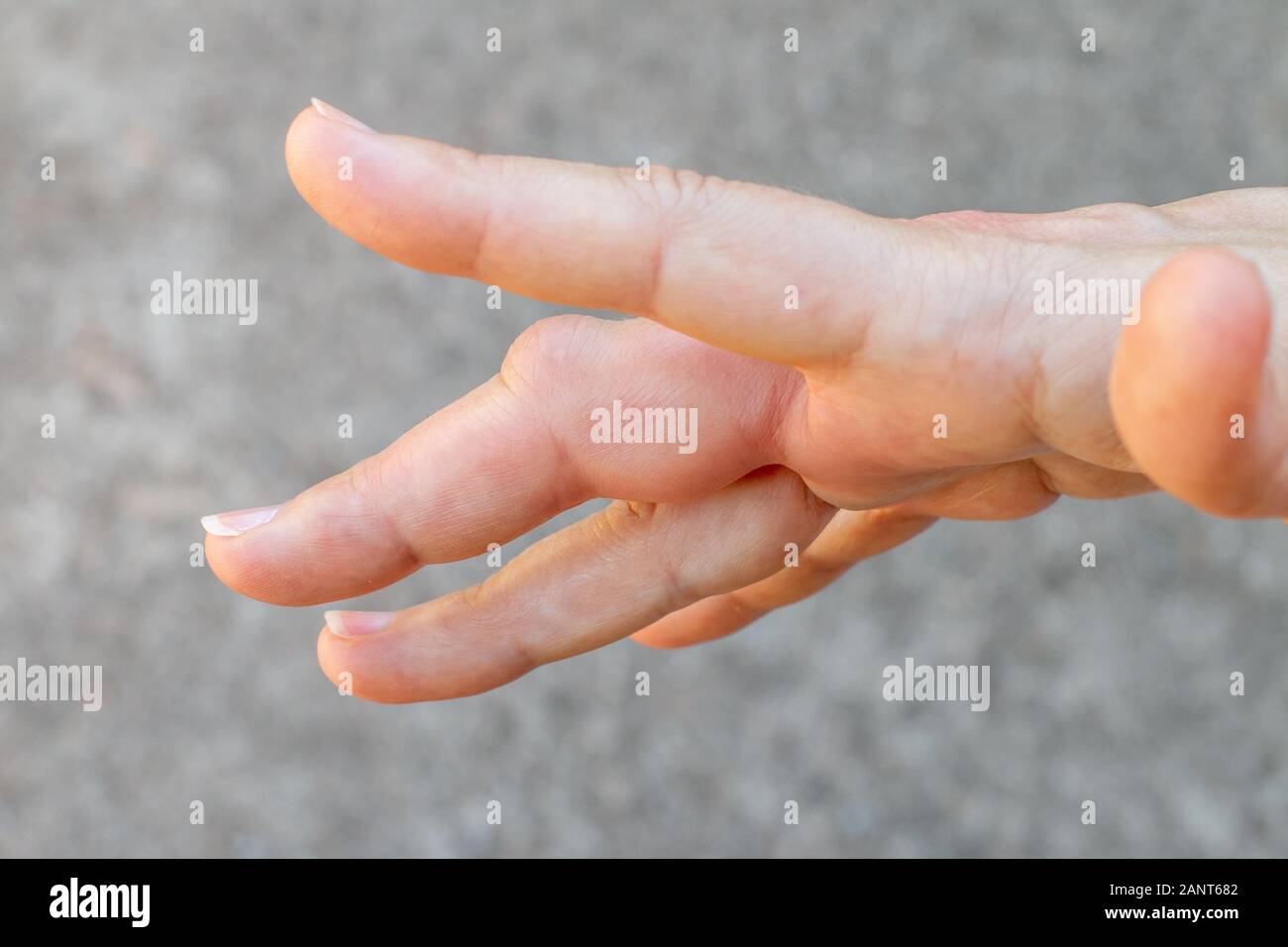 Eine mit der rechten Hand mit einer Biene, Wespe Bissenmarkierung, geschwollene Finger, Hand nach einer Biene Biss Stockfoto