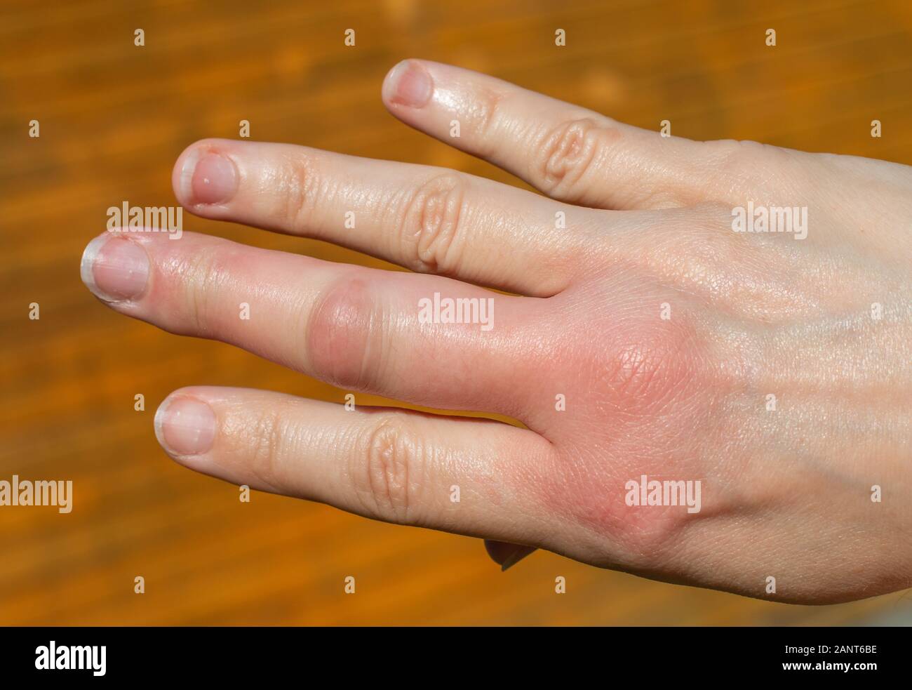 Eine rechte Hand nach einer Biene biss auf einer hölzernen Hintergrund, Schwellung der Hand, geschwollene Finger, Hand nach einem Bienenstich Stockfoto