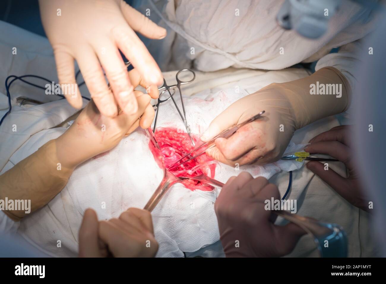 Ein Chirurg mit Assistenten, die in einem sterilen Operationssaal, ist auf die inneren Organe betrieben. Blau kalten OP-Leuchten. Die Hände des Chirurgen halten Sie die INSTRUME Stockfoto