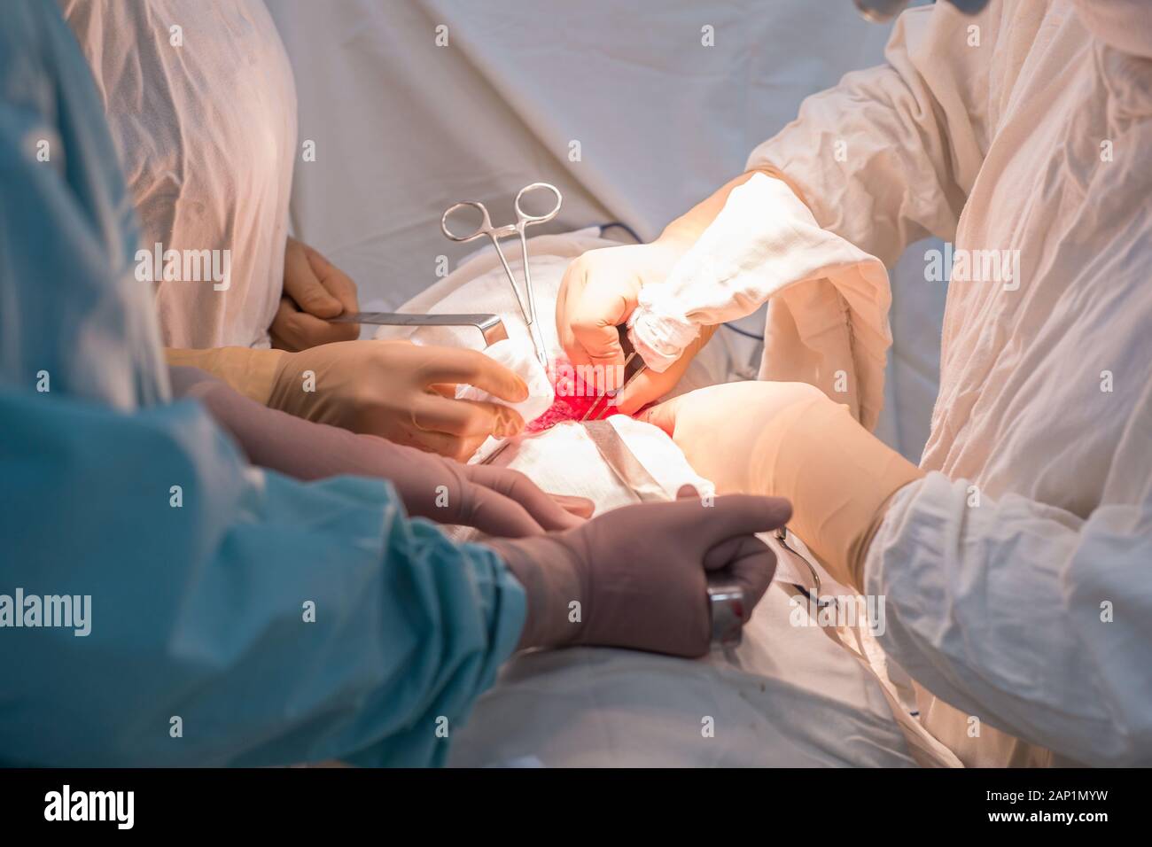 Ärzte - Kinder- Chirurgen, die in einem sterilen Operationssaal, eine Niere Operation durchführen. Der Chirurg Hände halten chirurgische Instrumente, manipulieren Stockfoto