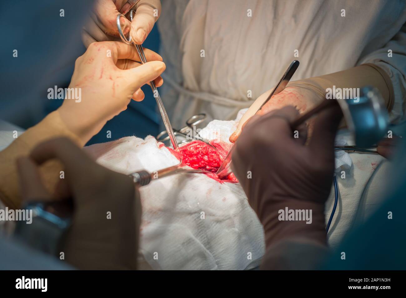 Ein Chirurg mit Assistenten, die in einem sterilen Operationssaal, ist auf die inneren Organe betrieben. Blau kalten OP-Leuchten. Die Hände des Chirurgen halten Sie die INSTRUME Stockfoto