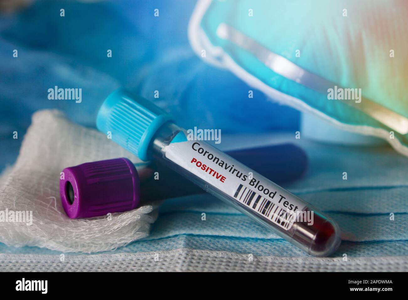 Positives Bluttestergebnis für das neue, sich schnell ausbreitende Coronavirus mit Ursprung in Wuhan, China Stockfoto