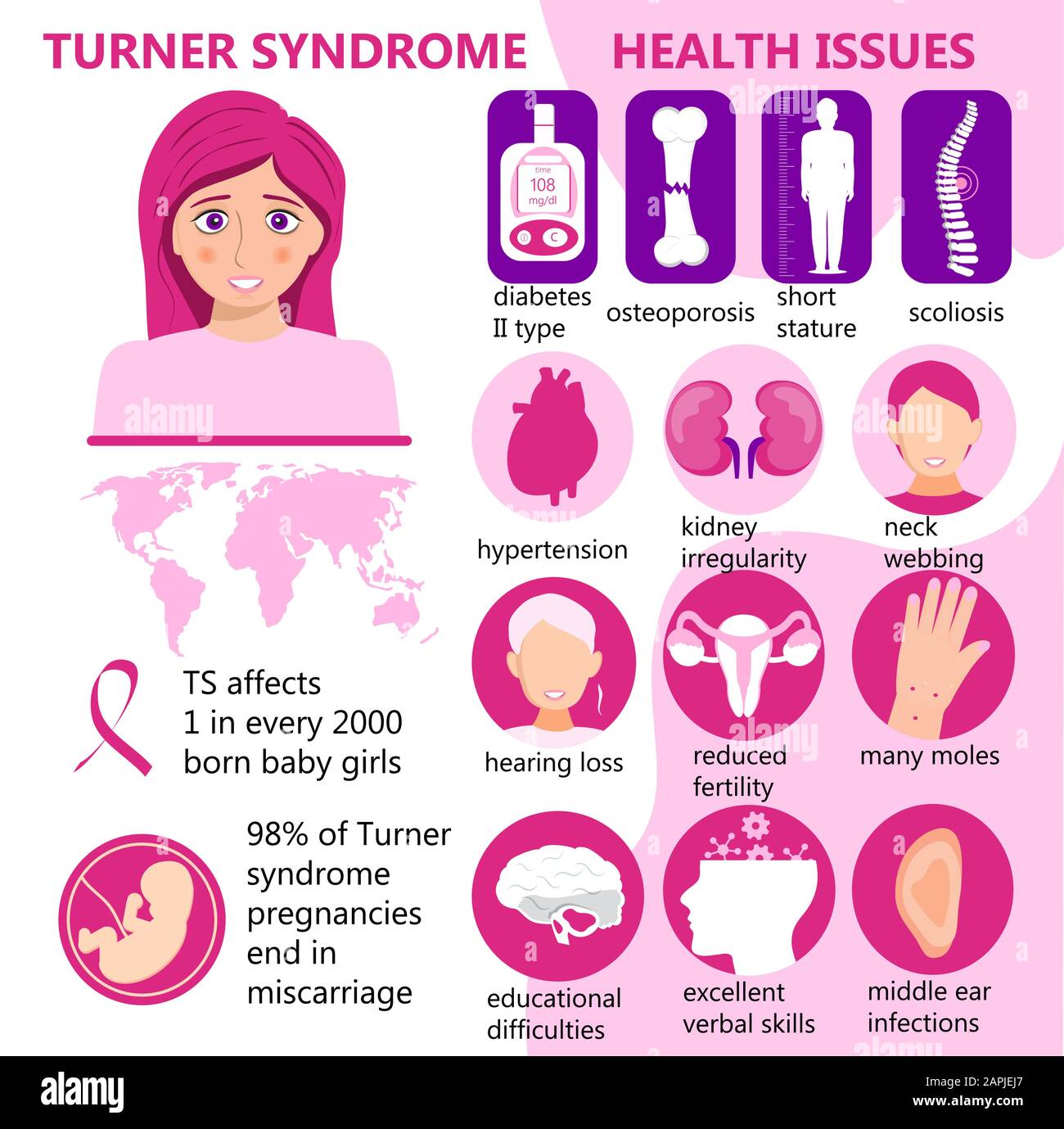 Infografischer Vektor des Turner-Syndroms. Zeichen, gesundheitliche Probleme. Kurze Statur, Nierenunregelmäßigkeit, reduzierte Fruchtbarkeit, viele Molen, Osteoporose und Diabetes Stock Vektor