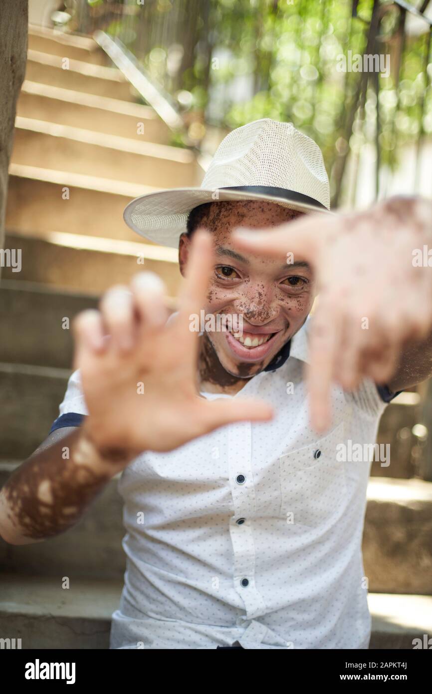 Porträt des jungen Mannes mit Vitiligo, der einen Hut trägt, der auf der Treppe sitzt und sein Gesicht mit den Händen umrahmt Stockfoto