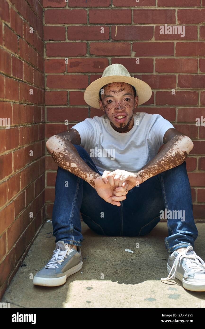 Porträt des jungen Mannes mit Vitiligo, der einen Hut trägt Stockfoto