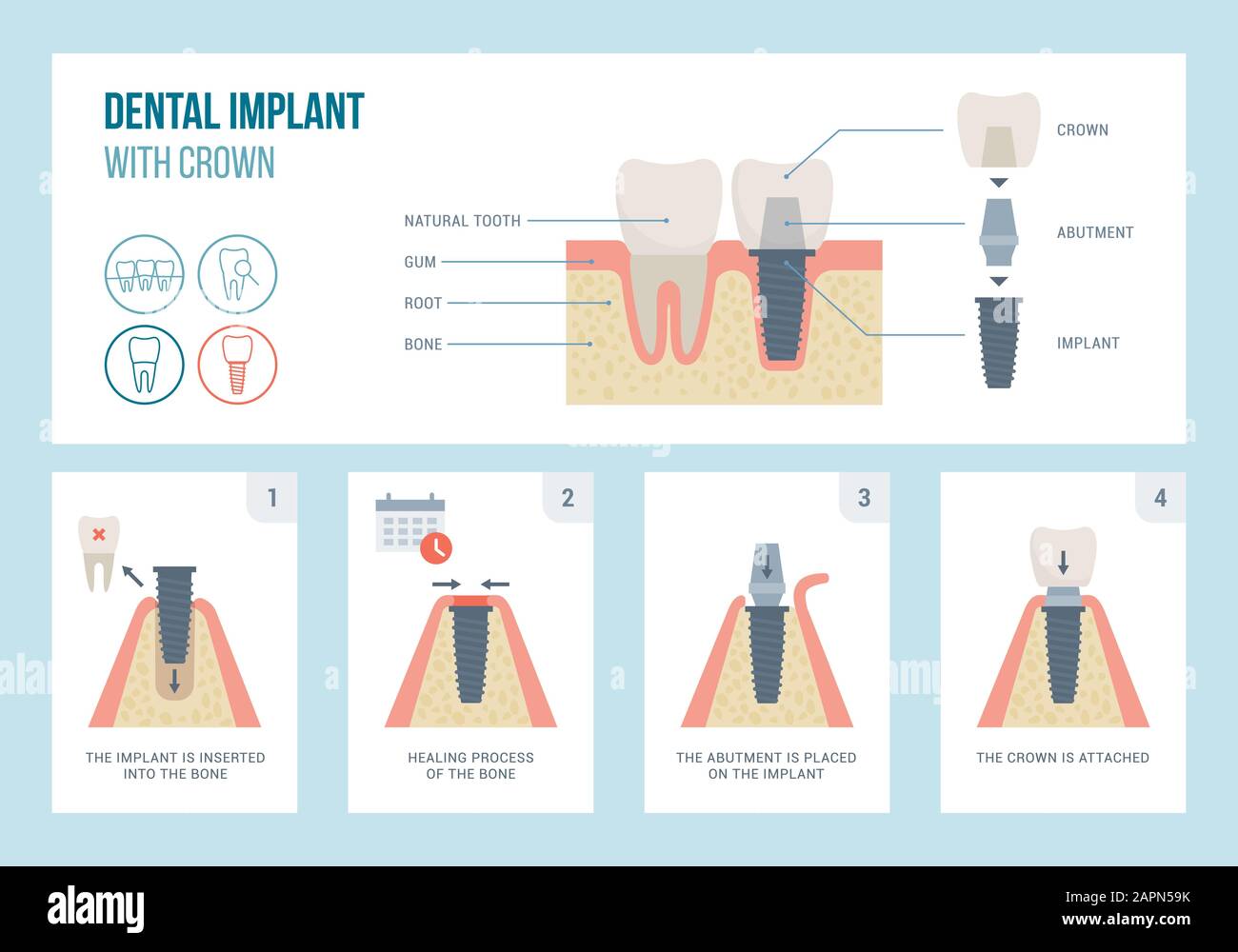 Medizinisches Verfahren und Struktur des Zahnimplantats, Zahnmedizin und Kieferorthopädische Konzepte Stock Vektor