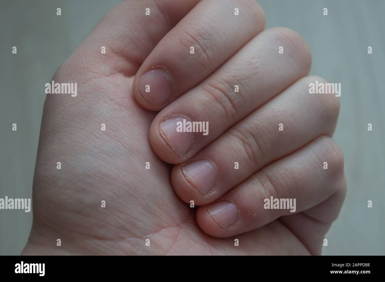Beschädigte Fingernägel schließen sich mit gelben Spitzen aufgrund von Angststörungen und Hautpickung/Dermatillomanie-Zustand. Konzeptionell für Stress, psychiatrisch c Stockfoto