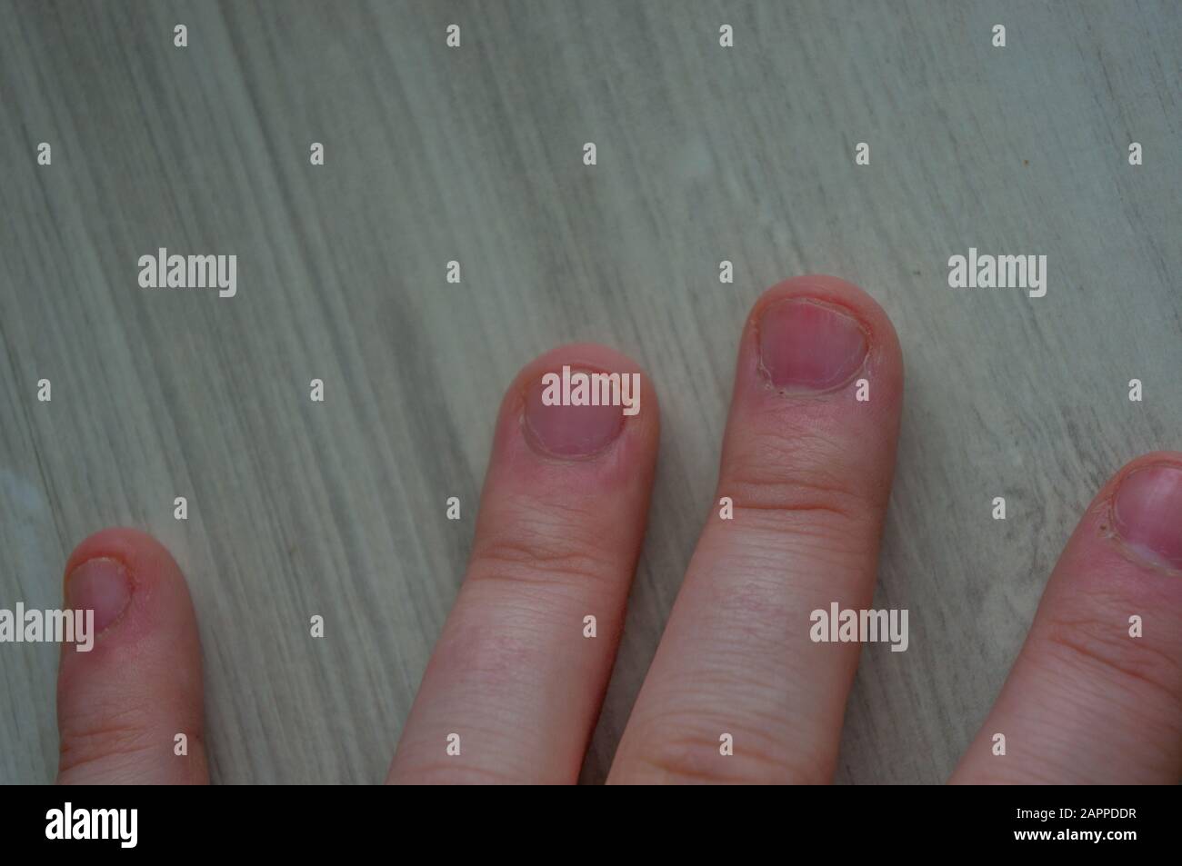 Beschädigte Fingernägel durch Beißen aufgrund von Angststörungen mit beschädigten Cuticles durch Hautpickung. Dermatillomanie bedrängnis und geschwollen und pink. Konce Stockfoto