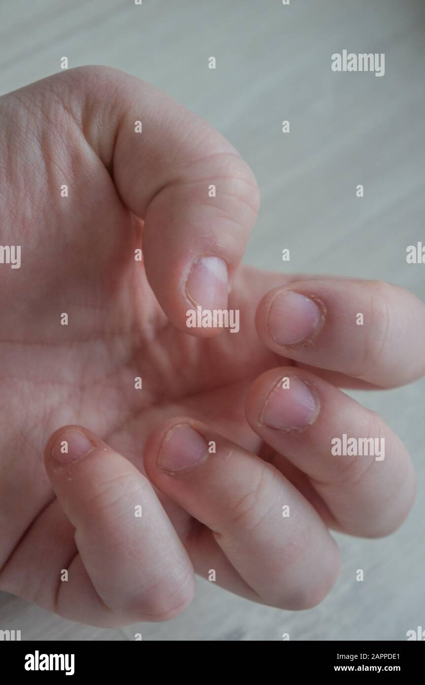 Gebissene Fingernägel, die aufgrund von Angststörungen mit beschädigten Cuticles durch Hautpickung beschädigt wurden. Konzeptionell für Stress, Depressionen oder medizinische Zwecke. Stockfoto