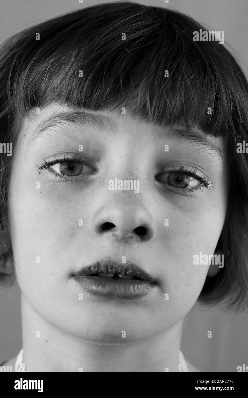 Schwarz-Weiß-Porträt eines kranken Kindes mit gekappten Lippen Stockfoto