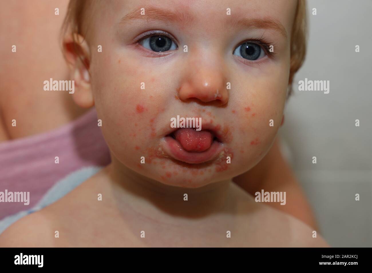 Maul- und Klauenseuche im Kindesalter Stockfoto