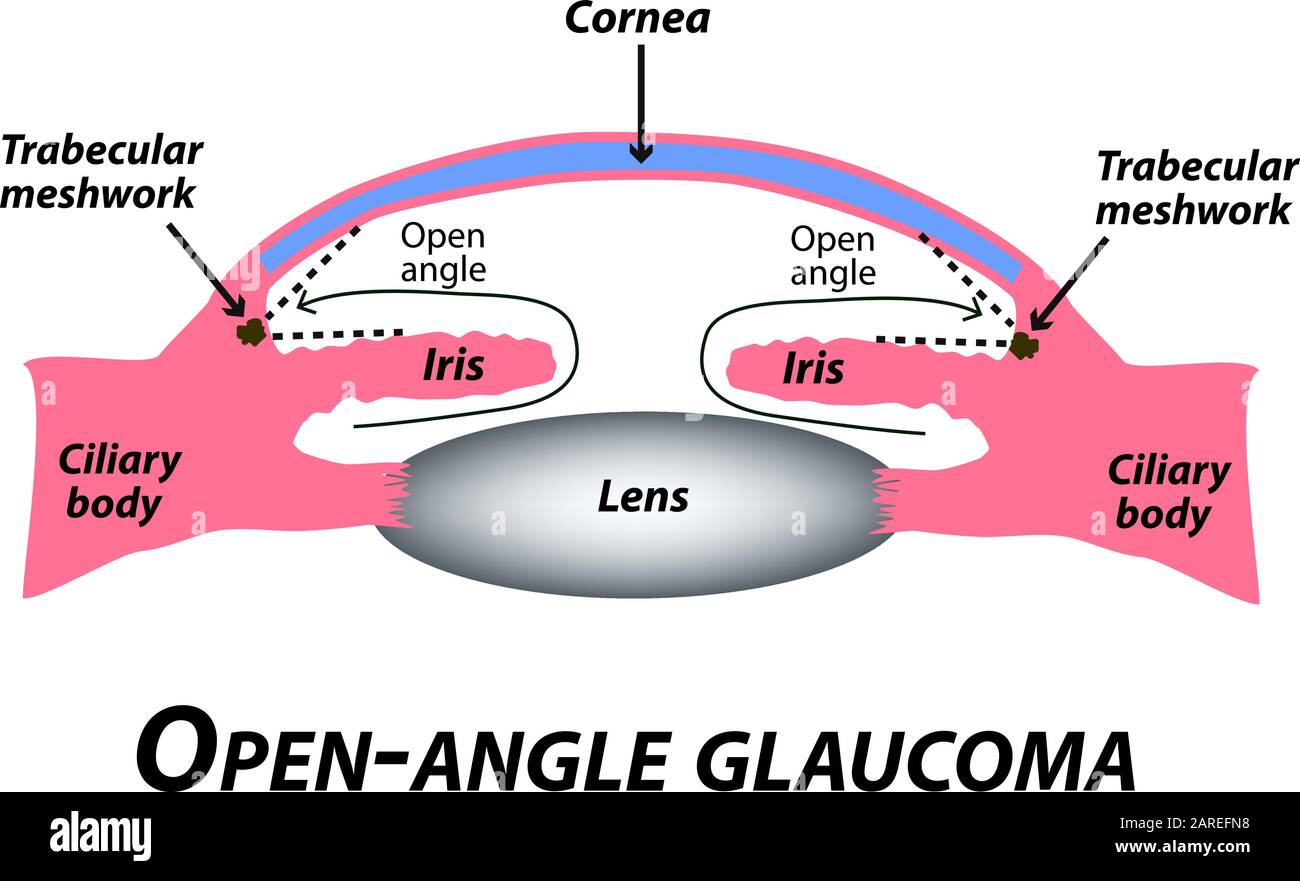 Offenes Glaukom. Eine häufige Art von Glaukom. Die anatomische Struktur