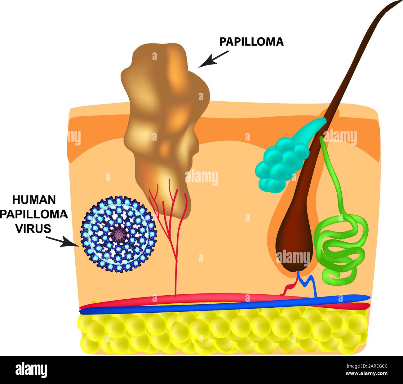 Das humane Papilloma-Virus verursacht die Bildung von Papillomen auf der Haut. Struktur. Infografiken. Vektordarstellung auf isoliertem Hintergrund. Stock Vektor