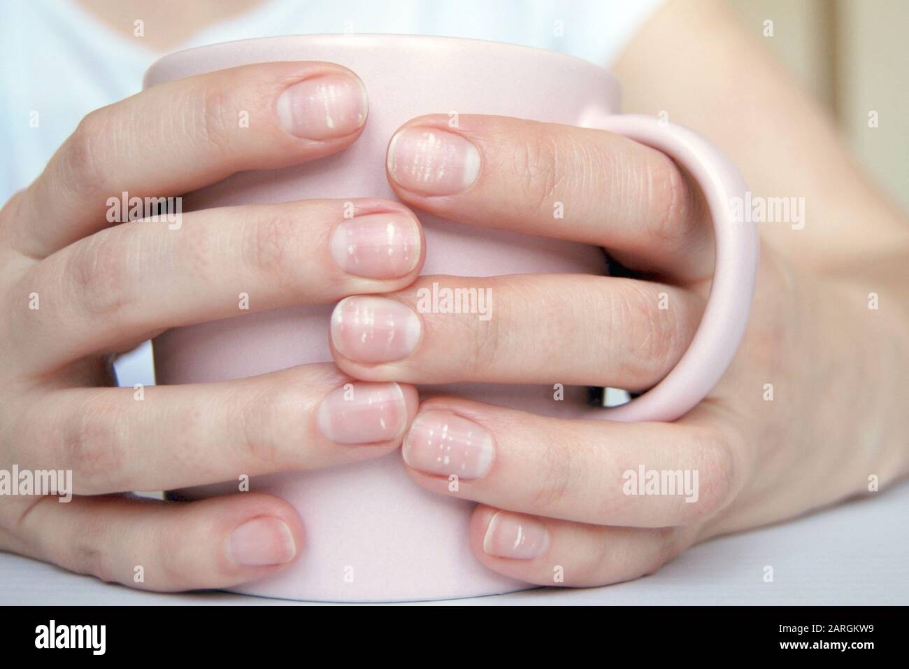 Viele weiße Flecken auf den Fingernägeln (Leukonychia) aufgrund von Kalziumdefizit oder Stress. Weibliche Hände halten Becher Stockfoto