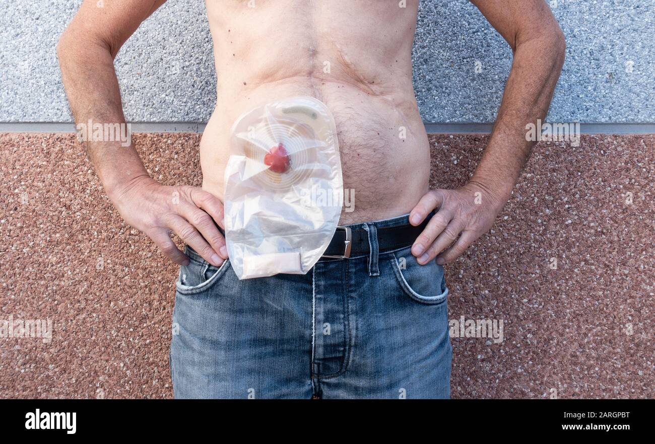 Reifer Mann mit Stom mit transparentem Ileostomie-Beutel. Siehe Abbildung 2ARGPBC für vollständige Beutel vor dem Wechseln. Stockfoto