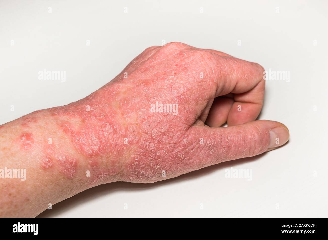 Allergische Hautläsionen der Hand mit Rissen, Entzündungen und Abblättern. Psoriasis, atopische Dermatitis, Ekzeme. Hautprobleme Stockfoto