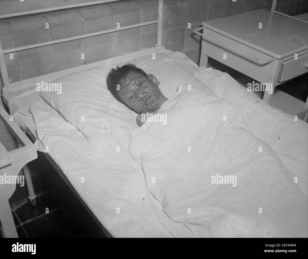 Indonesier, die von Pocken Boy betroffen sind, liegen in einem Krankenhausbett Datum: 22. Januar 1949 Standort: Indonesien, Niederländische Ostindien Stockfoto