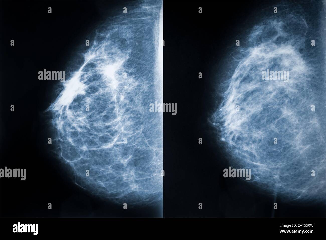 Vergleich zwischen Brustkarzinom (links) und gesunder Brust (rechts). Röntgenbilder oder Röntgenaufnahmen von Brustkrebs. Bilder aus der Medizin und dem Gesundheitswesen. Stockfoto