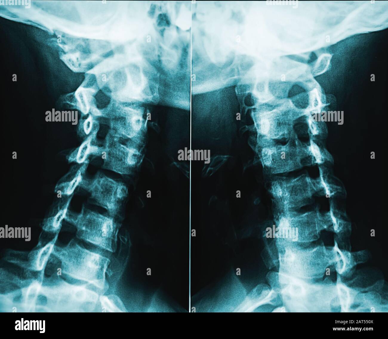 Röntgenbild oder Radiographie der männlichen Halswirbel oder Halswirbel des Menschen. Stockfoto