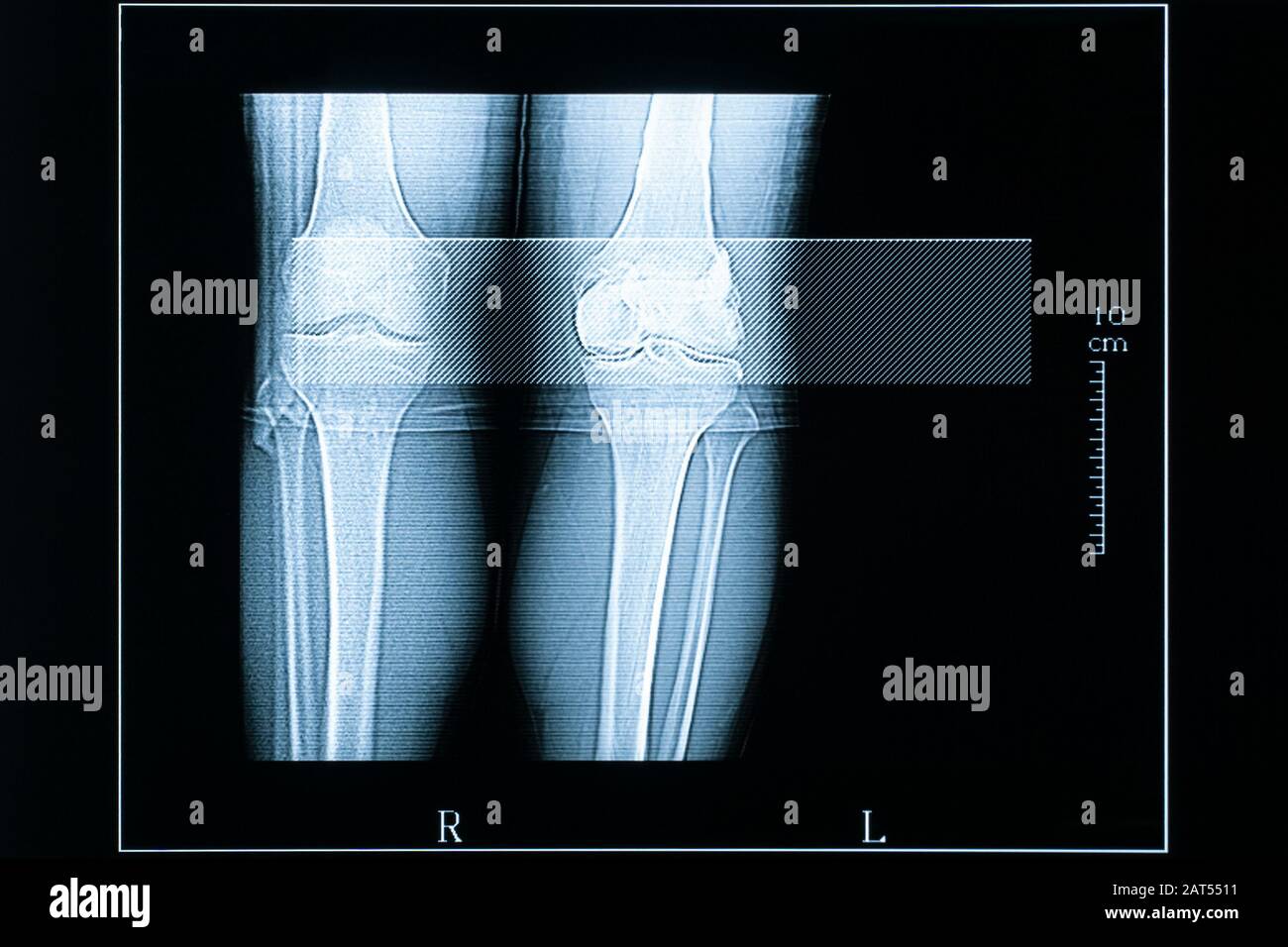 CT-Scan mit jungen männlichen (25 Jahre alt) linken und rechten Knien. Bilder aus der Medizin und dem Gesundheitswesen mit einer Skala von Zentimetern. Linkes Knie verletzt. Stockfoto