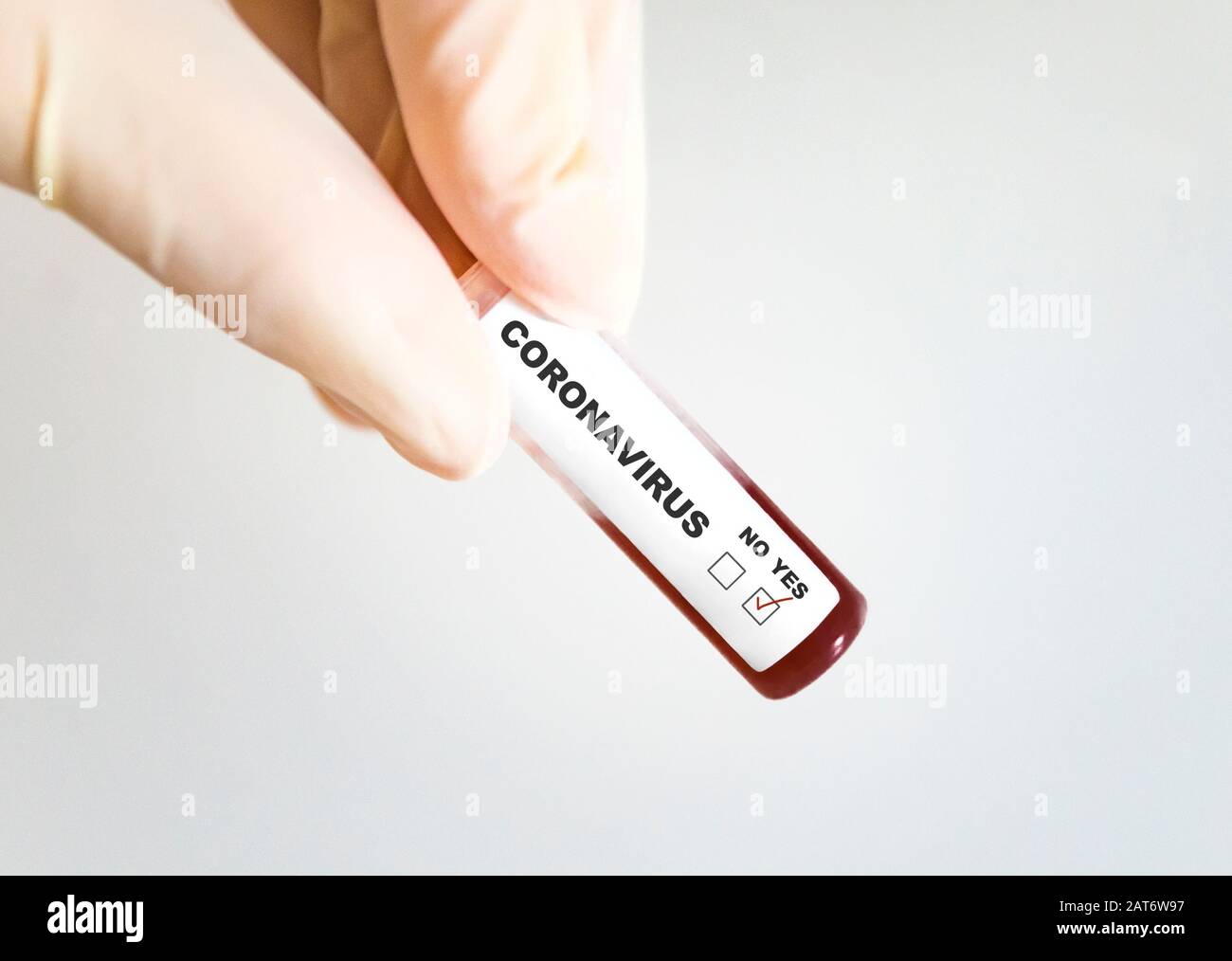 Reagenzglas mit Blut, das mit Coronavirus infiziert ist Stockfoto