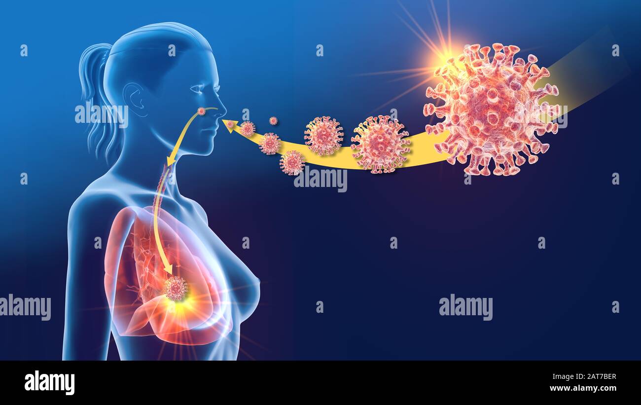 3D-Darstellung mit Corona-Virus, MERS-VIRUS, Middle East Respiratory Syndrom, Pneumonie, Lunge Stockfoto