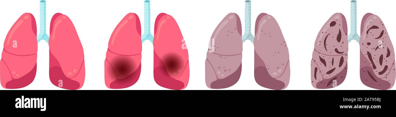 Lungenkrankheiten Progression eingestellt. Gesunde Entzündung Pneumonie und Tuberkulose Virusinfektion. Das innere Organvirus des menschlichen Atmungssystems schlug ein. Medizinische anatomische Schäden Vektor eps illusrtation Stock Vektor