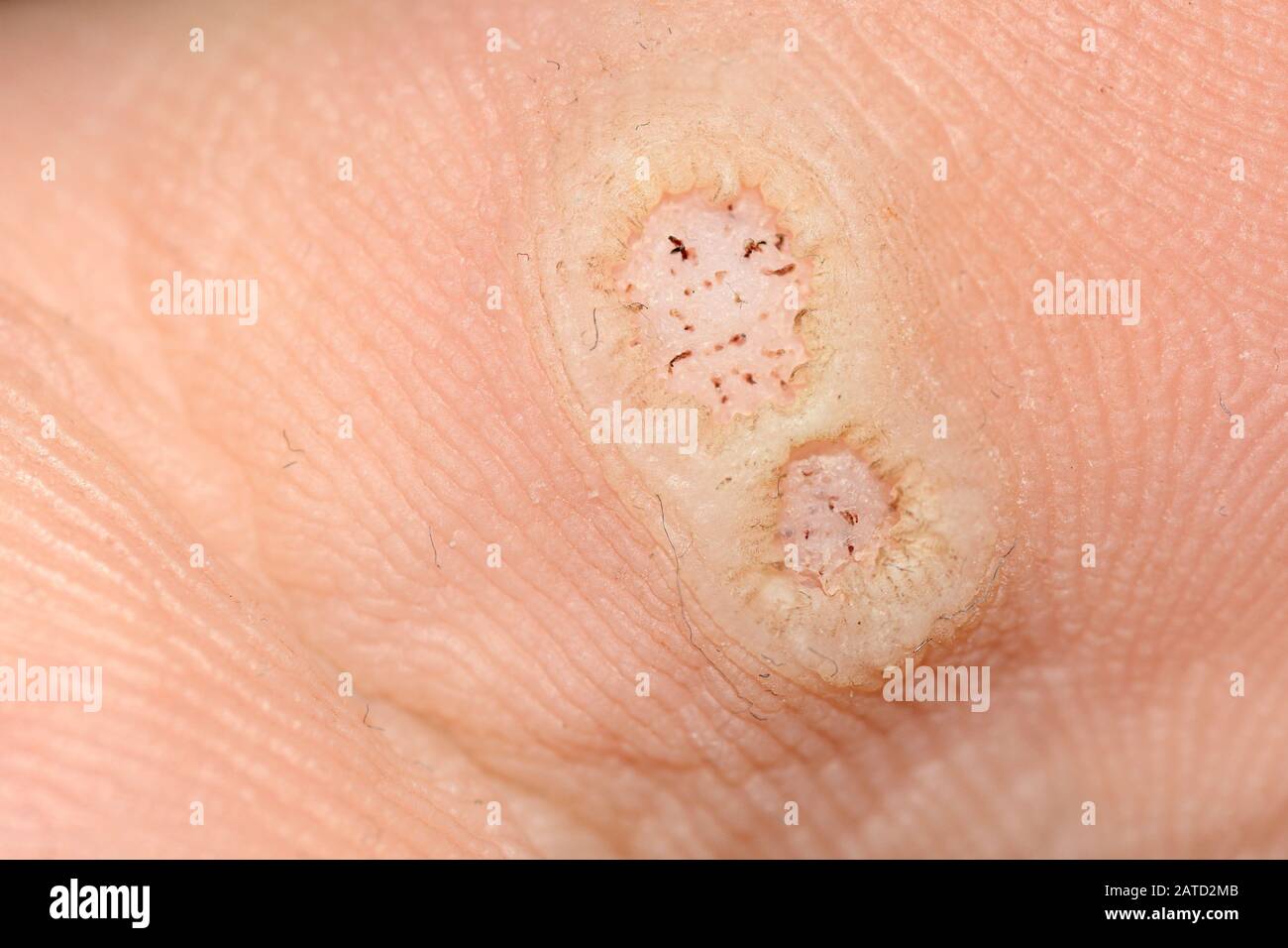 Plantare Warzen, die durch das humane Papillomavirus oder HPV verursacht werden, auf einem infizierten Fuß Stockfoto
