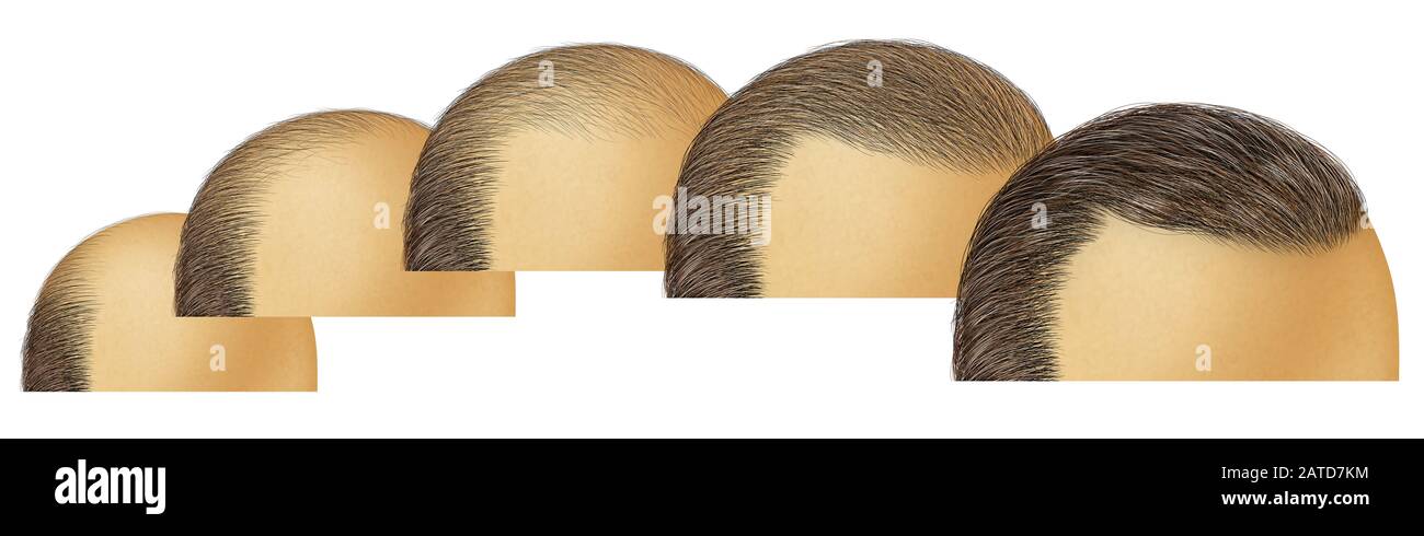 Kahlkopfhaarwachstum als redende Haarsträhne kosmetische Follikelbehandlung oder Alopezie wie früher und später. Stockfoto